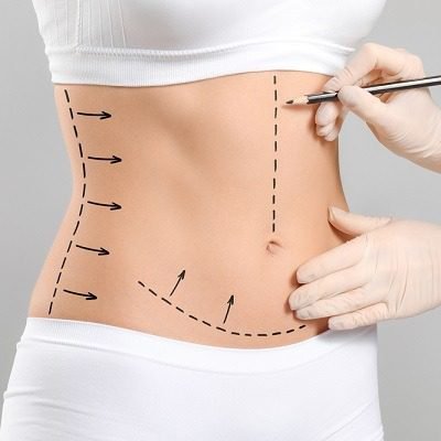 Circumferential abdominoplasty tummy tuck cost and results in Dubai