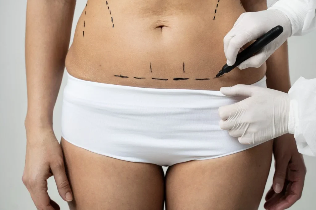 Mini Tummy Tuck Dr. shahram e1708978805979 - Cocoona Plastic Surgery Dubai