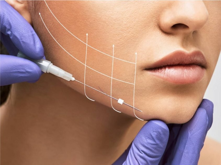 Thread lift non-surgical facial tightening procedure Dubai