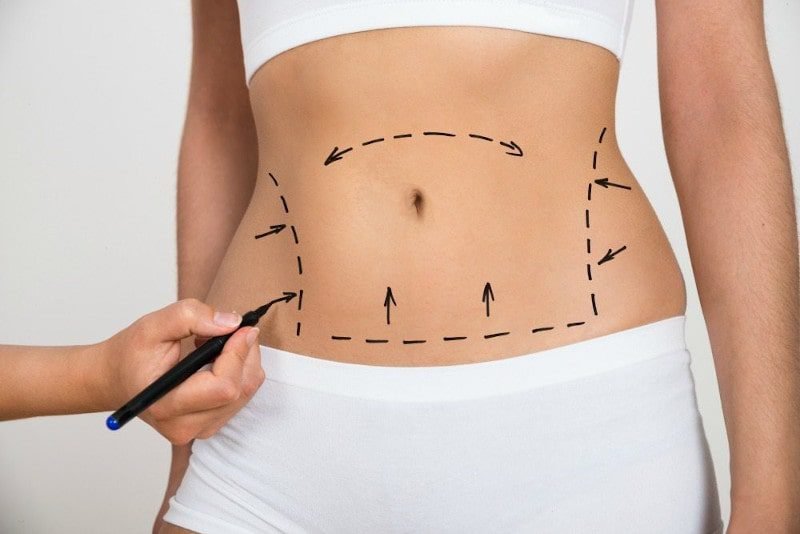 Types of tummy tuck abdominoplasty procedures available in Dubai