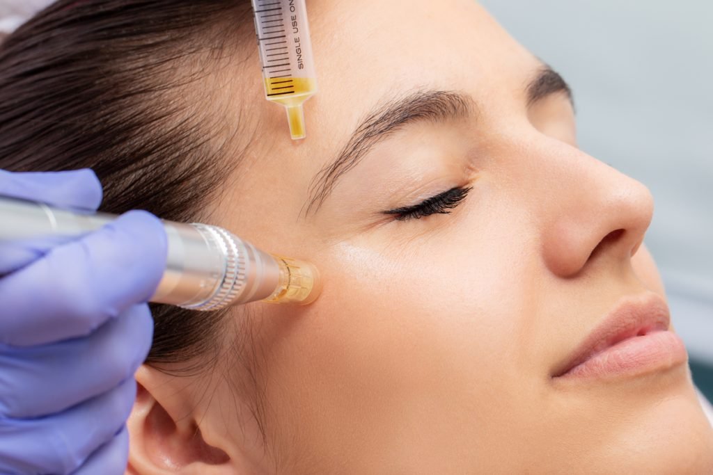 PRP platelet rich plasma vampire facial treatment Dubai