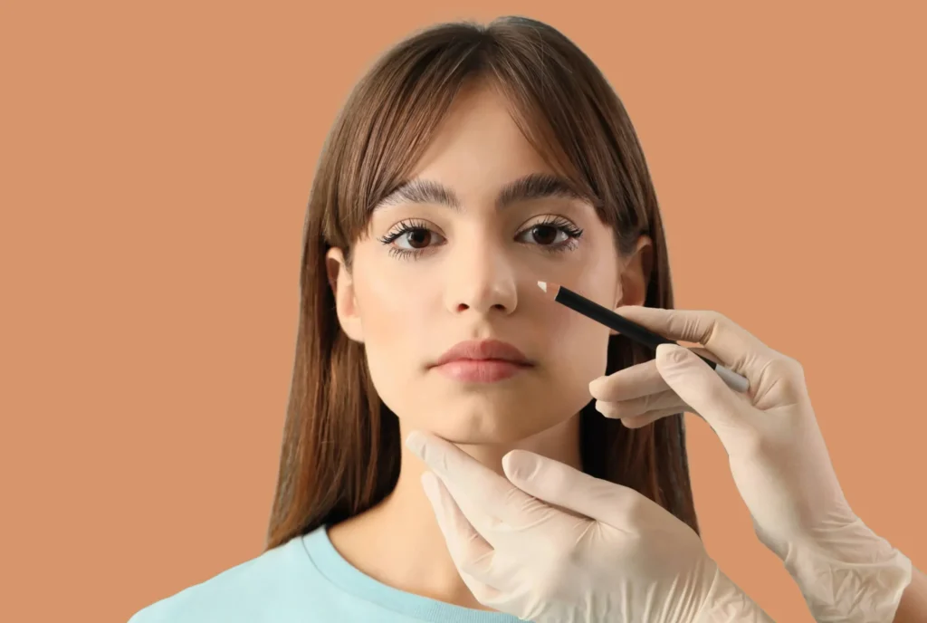 rhinoplasty-gc-marker