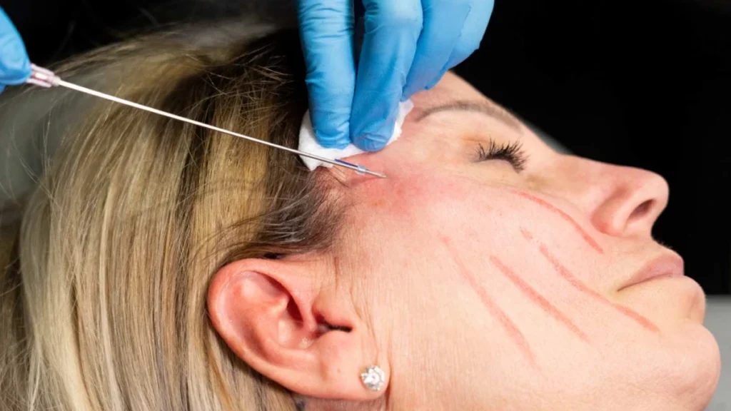 pdo-thread-lift-non-surgical-face-lift-chicago