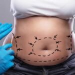 tummy tuck in dubai - Cocoona Plastic Surgery Dubai