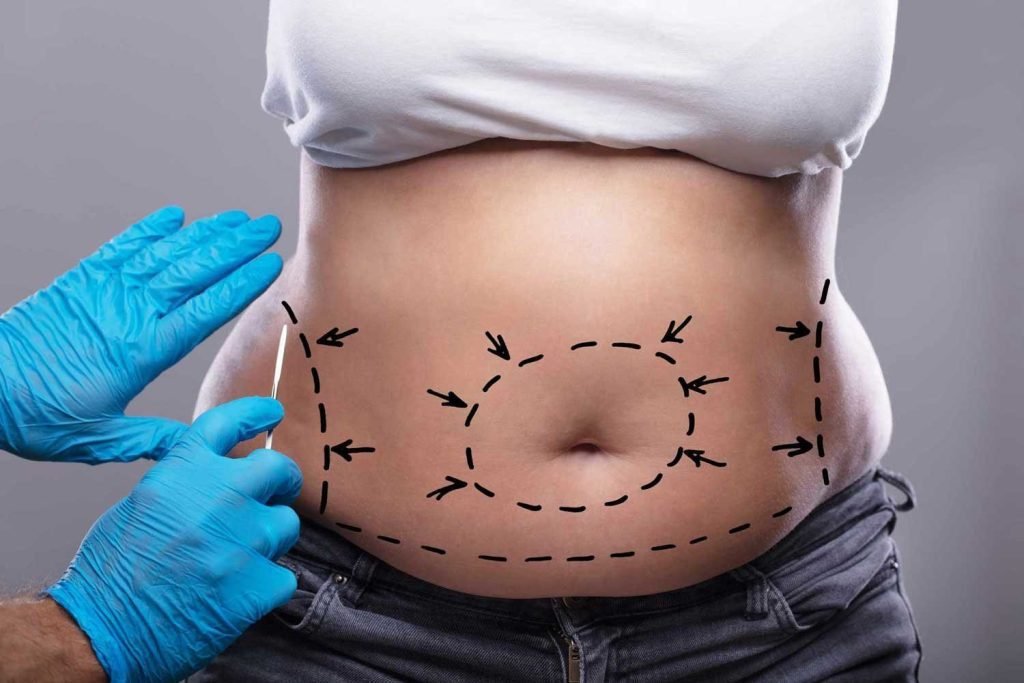 Liposuction in Dubai