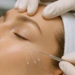 under-eye-thread-lift