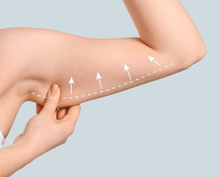 Arm lift brachioplasty procedure and results Dubai