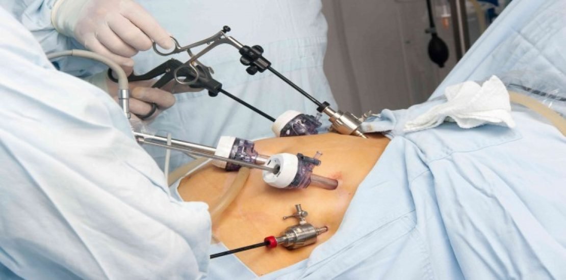 Bariatric-Surgery-Types-Benefits-and-Results