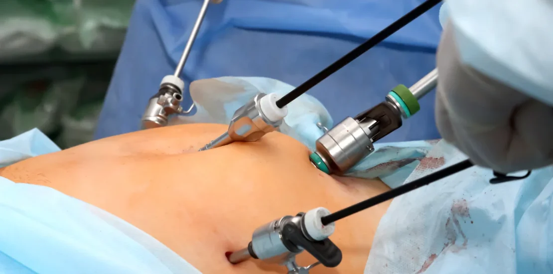 Laparoscopic-Cholecystectomy.png