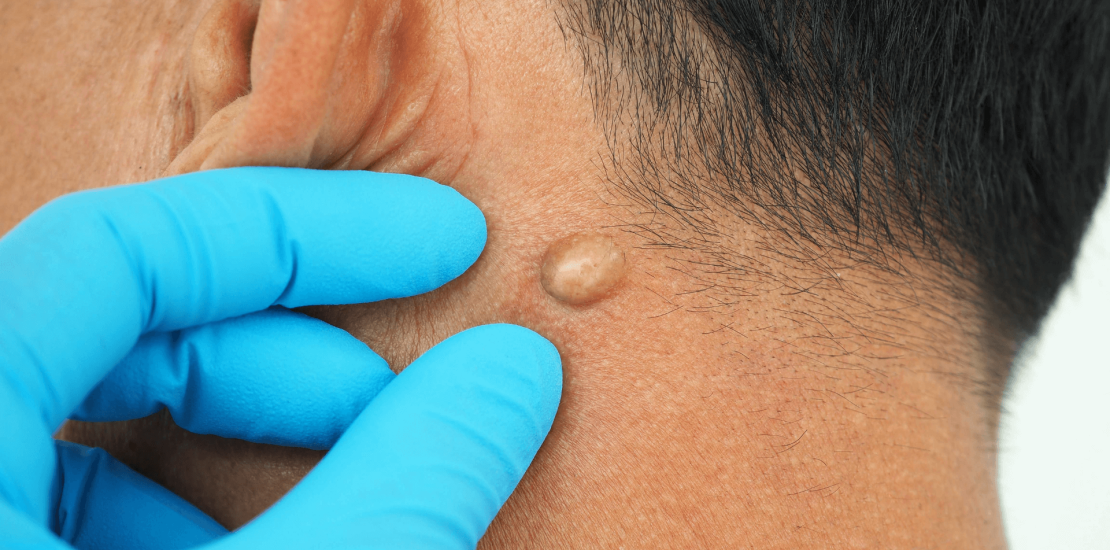 Lipoma Removal (1)