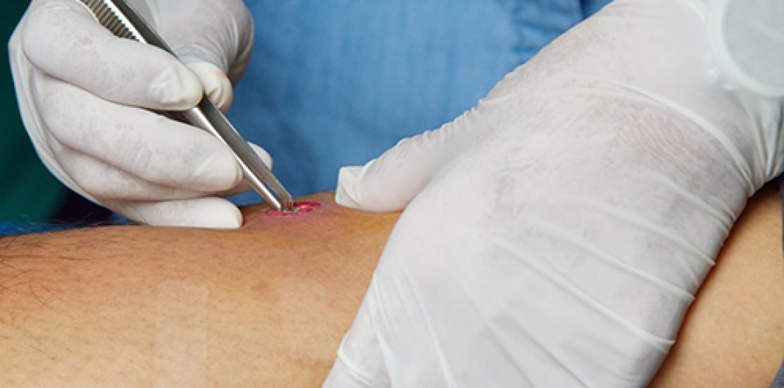 Nurse-was-drainage-pus-abscess
