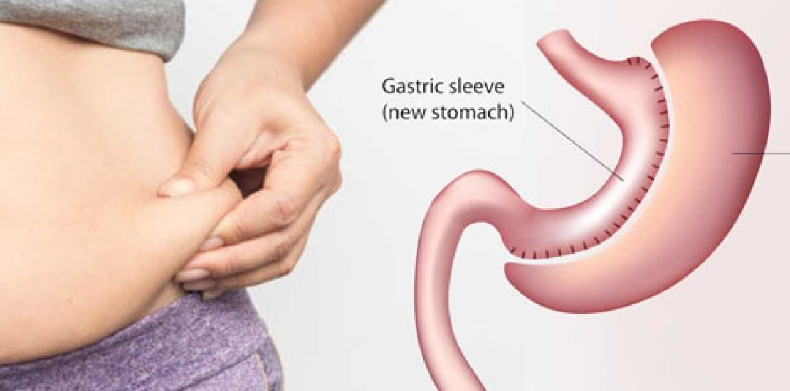 Sleeve-Gastrectomy