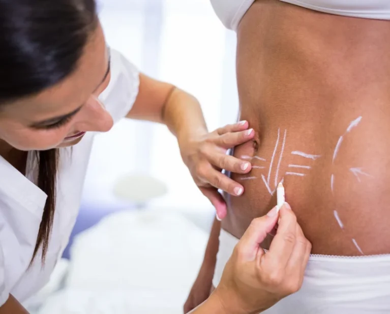 Tummy Tuck Price UAE - Cocoona Plastic Surgery Dubai