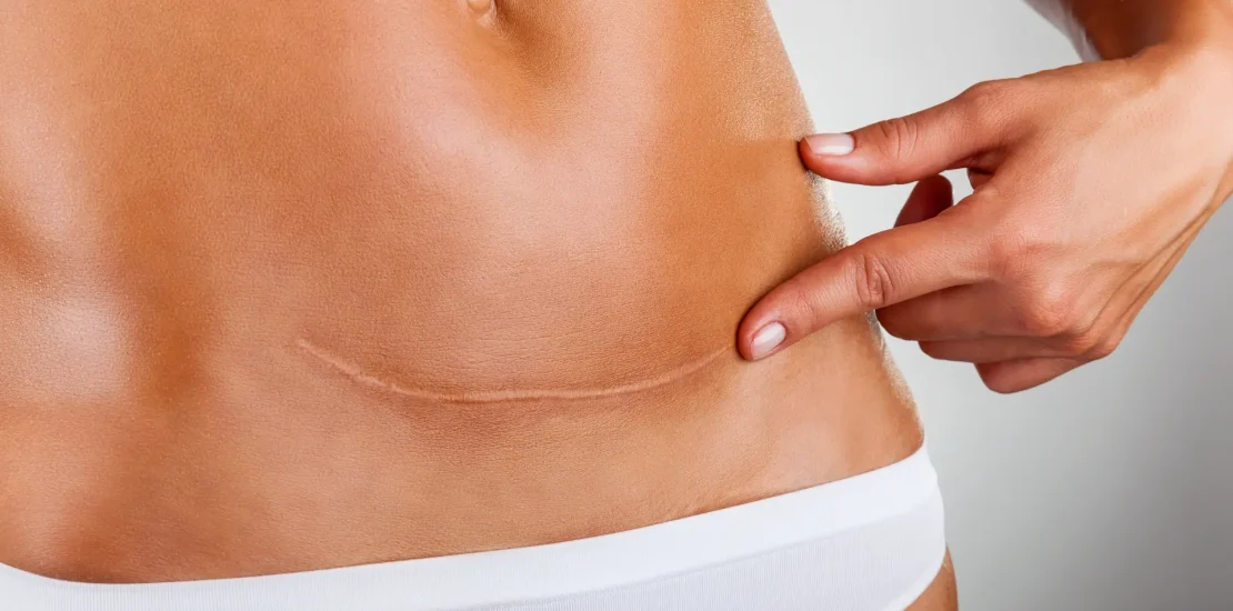 c-section-scar-after-childbirth