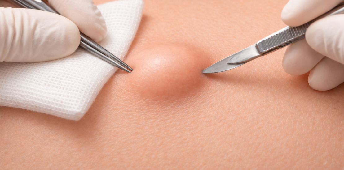 cyst-treatment