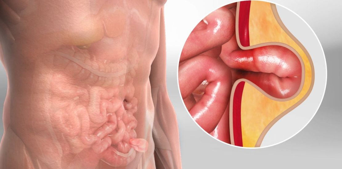 herniasurgery_1280