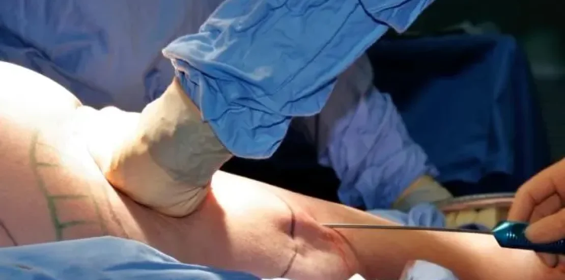 liposuction-operation