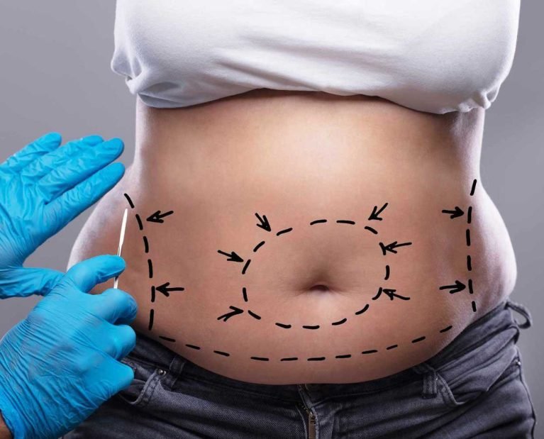 tummy tuck in dubai - Cocoona Plastic Surgery Dubai